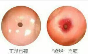 宫颈炎和宫颈糜烂傻傻分不清楚 宫颈炎和宫颈糜烂傻傻分不清楚