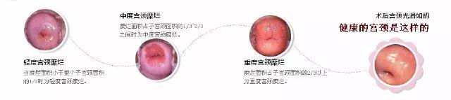 宫颈炎和宫颈糜烂傻傻分不清楚 宫颈炎和宫颈糜烂傻傻分不清楚