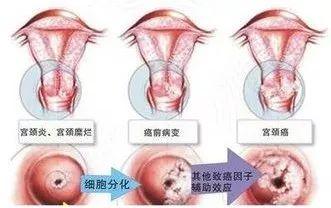 宫颈炎和宫颈糜烂傻傻分不清楚 宫颈炎和宫颈糜烂傻傻分不清楚