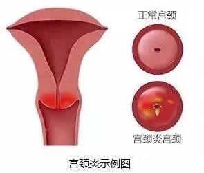 宫颈炎和宫颈糜烂傻傻分不清楚 宫颈炎和宫颈糜烂傻傻分不清楚
